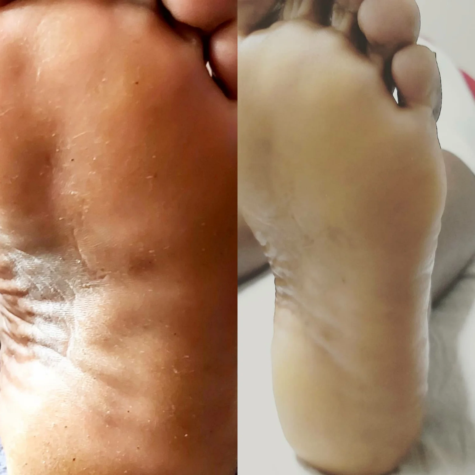 Sole before and after callus reduction