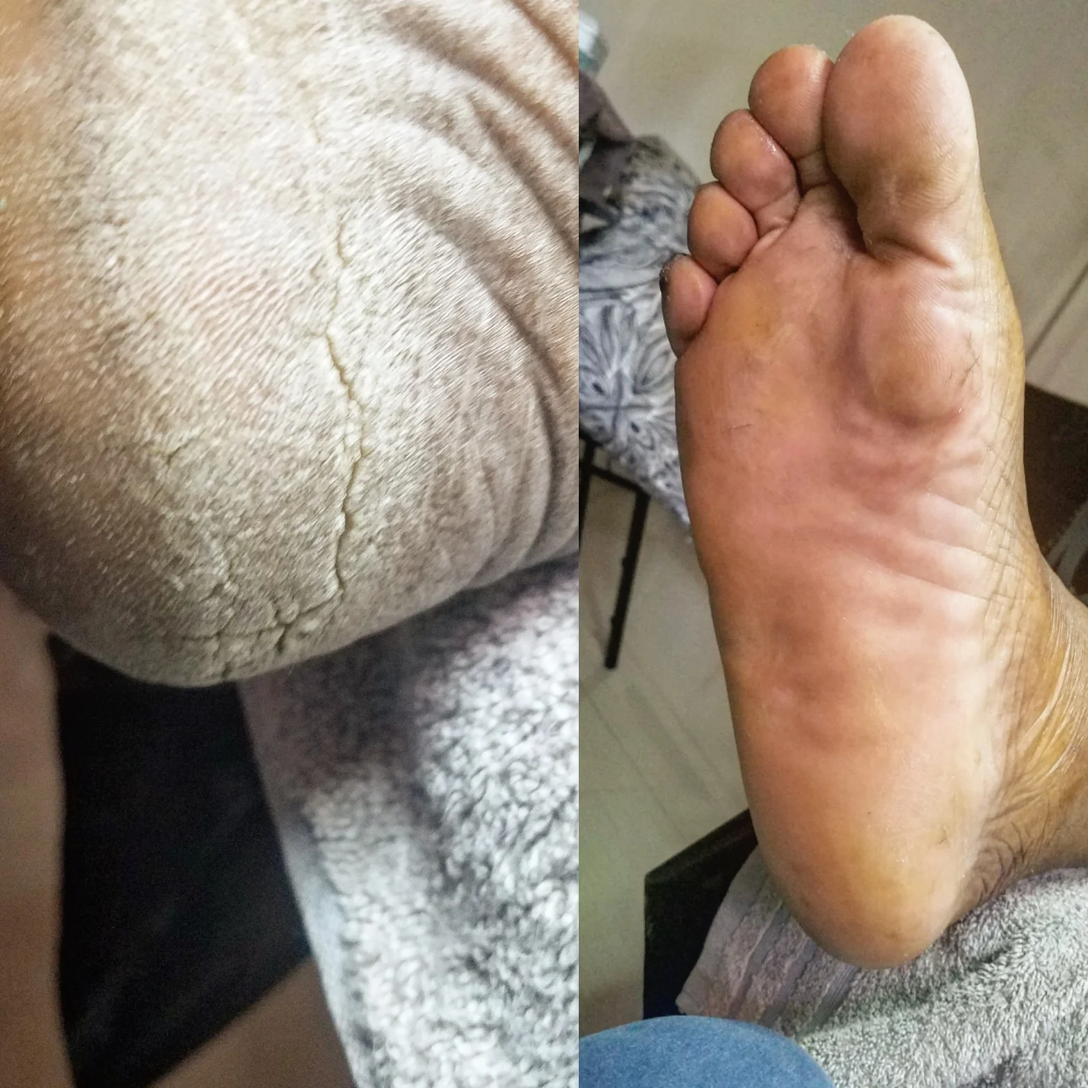 Cracked heel before and after sole care