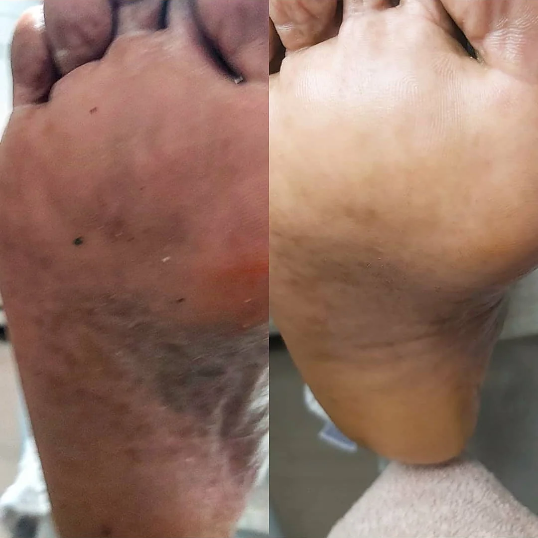 Heel before and after hard skin reduction