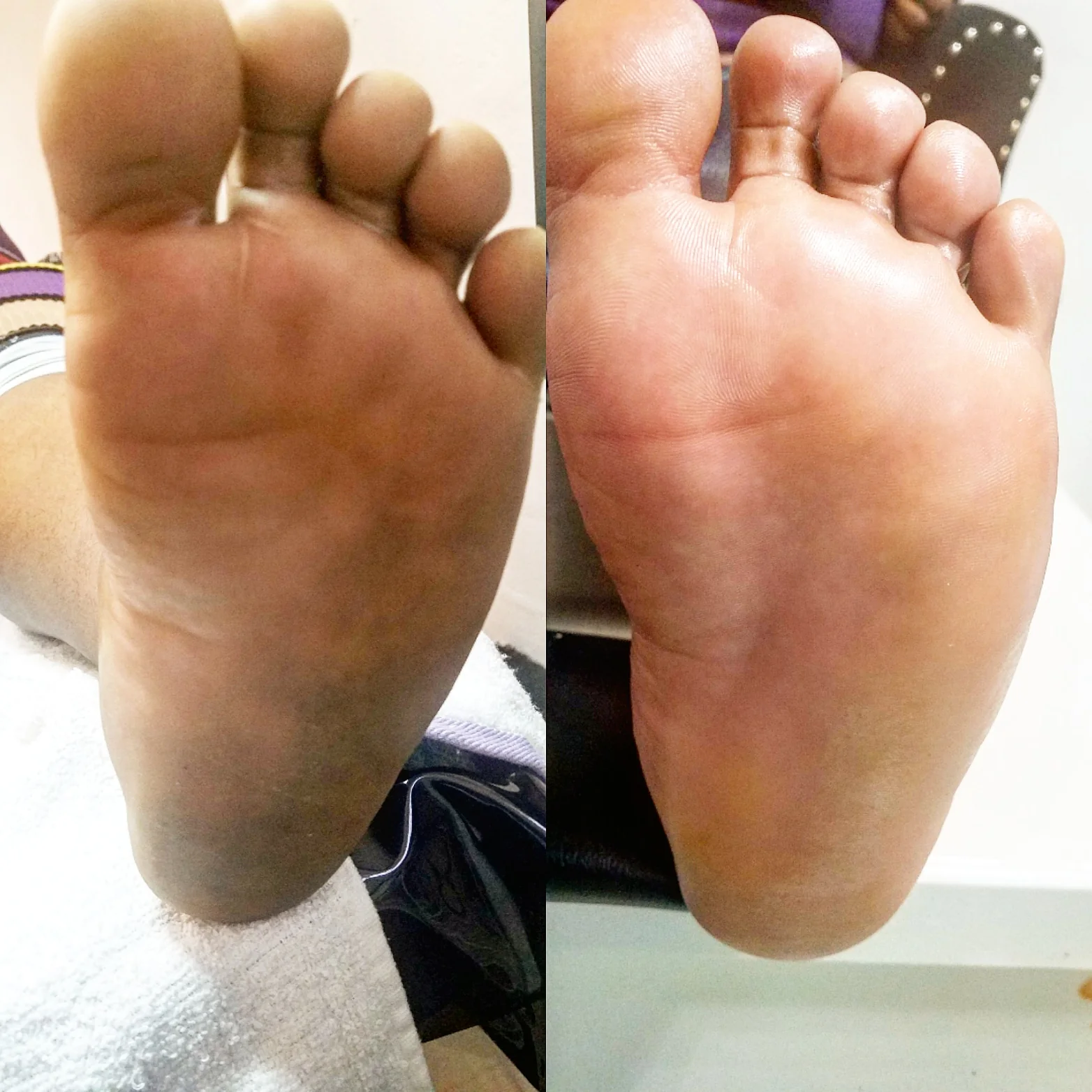 Soles before and after a medical pedicure