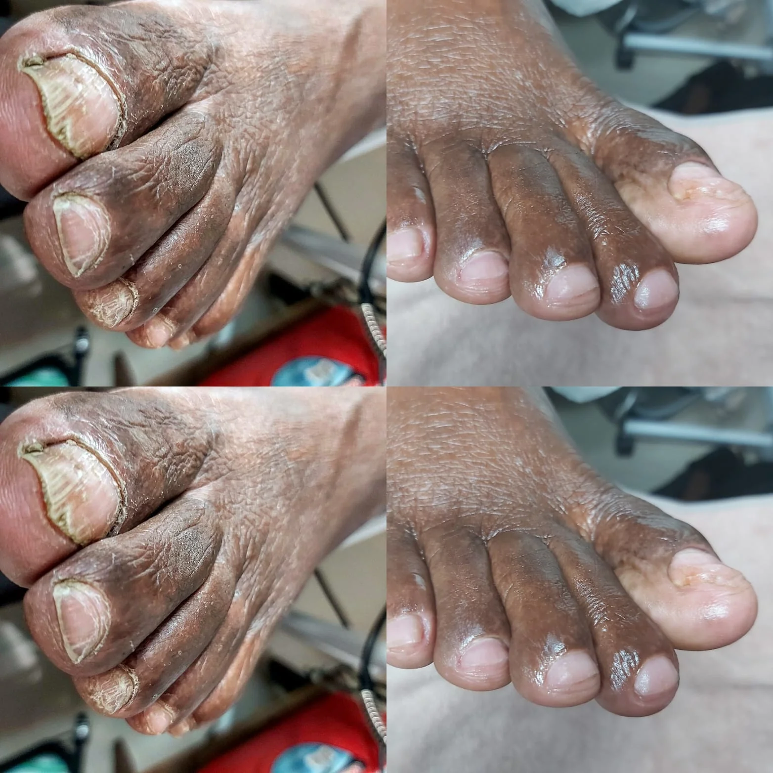 Toes before and after nail and skin care