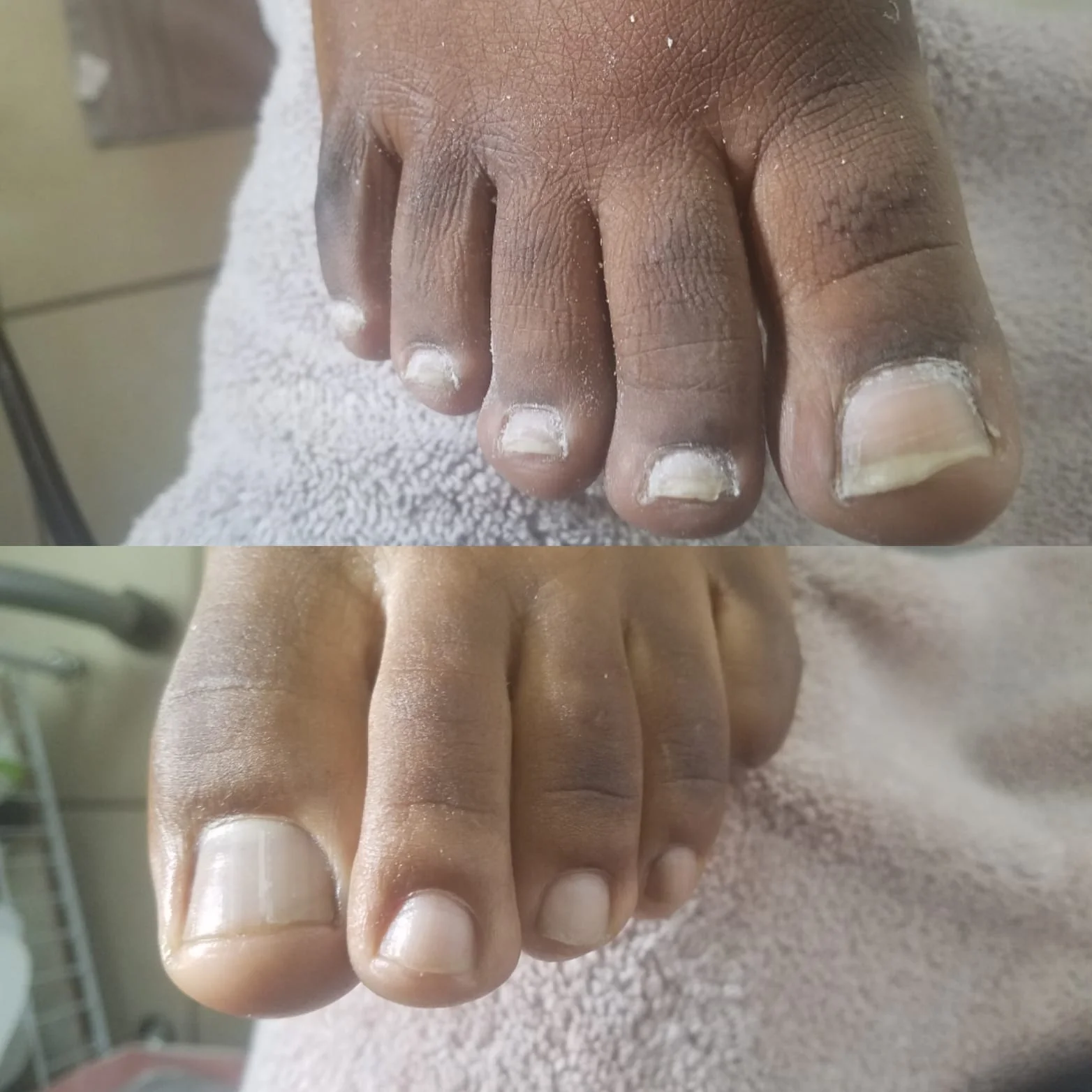 Toenails before and after trimming and nail care